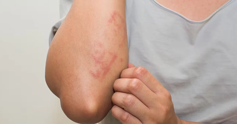 Sử dụng chung khăn tắm làm tăng nguy cơ mắc các bệnh ngoài da